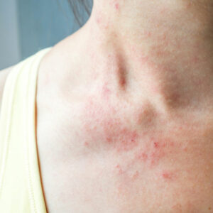 Mycosis fungoides – more than just a skin rash