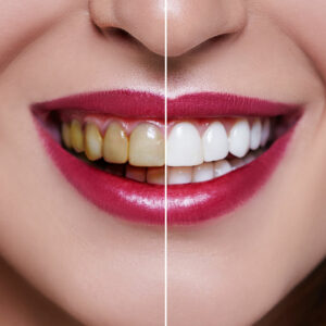 Dental veneers’ cost, procedure, and results