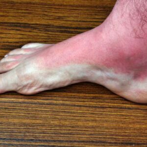 Heat rash: Causes, symptoms, and treatment