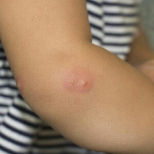 Here’s What You Need to Know about Shingles and Its Symptoms