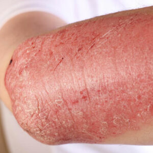 Immune system disorder – Symptoms, causes, and risks